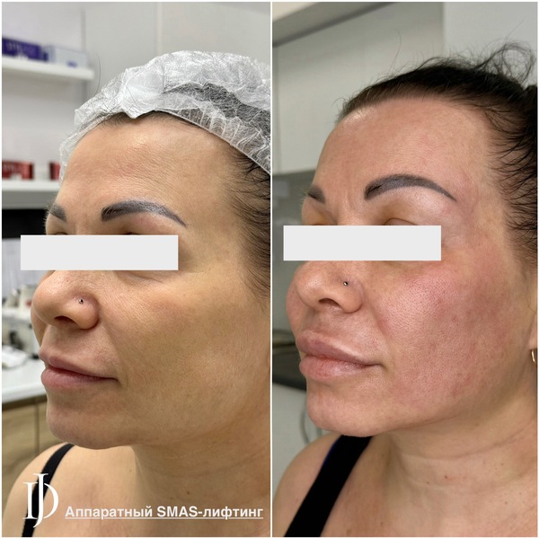 SMAS-лифтинг