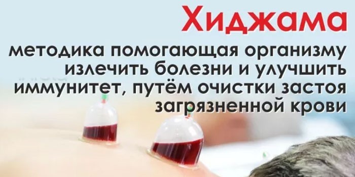 ХИДЖАМА в Ростове-на-Дону или выезд. звоните ХИДЖАМА в Ростове-на-Дону или выезд. звоните